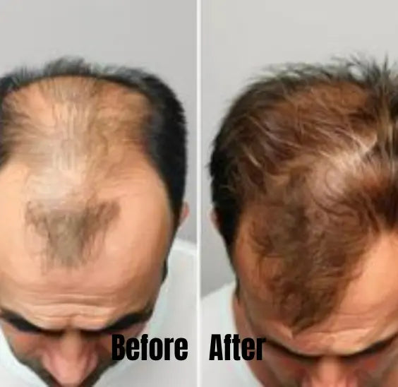 Care4Hairs Herbal Hair Oil| Hair Fall Control -200ml